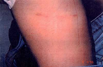 before_&_after_leg_scar_2.jpg