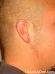 keloid_after_scar_treatment.jpg