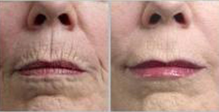 derma-roller--for-wrinkles-before-and-after.jpg