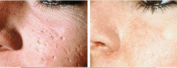 dermaroller-for-acne-before-and-after.jpg