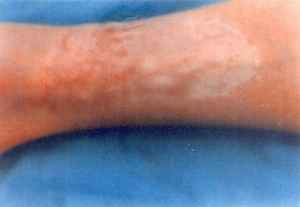 after_arm_scar3.jpg