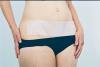 View: Tummy Tuck Scars 