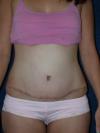 View: Post Surgical Tummy Tuck Scarring Treatment