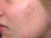 View: Acne Scars