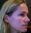 View: Dark Spot, Mole, Wart Remover