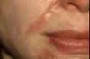 View: Before &amp; After Burn Scar Pictures