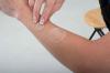 View: Forearm scar treatment