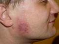 View: Red Scar Treatment