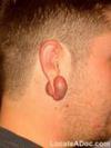 keloid_after_scar_treatment.jpg