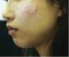 View:  Before &amp; After Acne Scar Pictures
