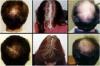 View: Hair Loss Treatment 