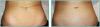 View: Stretch Mark Removal Before and After Photos