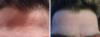 View: Wrinkle Removal Before and After Photos