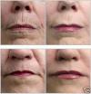 View: Derma Rolling Addition Information