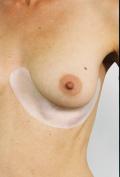 One Scar Healing 23 cm (9") Breast  Arc