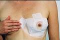 One Scar Healing 23 cm (9) Breast  Circle and Arc