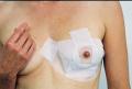 Two Scar Healing 23 cm (9 ") Breast Circle and Arc