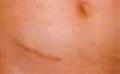 Appendectomy Silicone Sheets