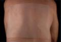 Scar Healing Silicone Sheet 10 cm x 20 cm (4" x 8") 