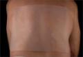 Scar Treatment Silicone Sheet 15 cm x 20 cm (6" x 8")  