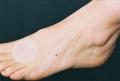 Scar Healing Silicone Disc  4.25 cm (1.6") diameter (9 discs per package)