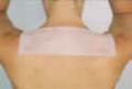 Scar Treatment Silicone Sheet 15 cm x 20 cm (6" x 8")  