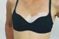 Two Scar Healing 28 cm (11") Breast Circle and Arc 