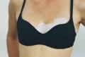 Breast Scar Treatment  (Arcs)