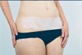 Scar Healing Silicone Sheet 8 cm x 85 cm (3" x 35") 