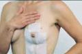 Breast Scar Treatment  (Vertical-Lollipop)