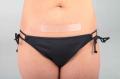 C-Section Scar Treatment Kits