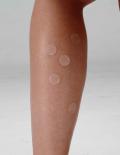  Adhesive Mini Silicone Discs For Insect Bites