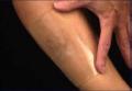 Scar Healing Silicone Sheet 4 cm x 8 cm  (1.6" x 3.2")