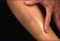 Scar Healing Silicone Sheet 4  cm x 18 cm  (1.6 x 7.2)