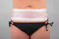 Tummy Tuck Scar Treatment 