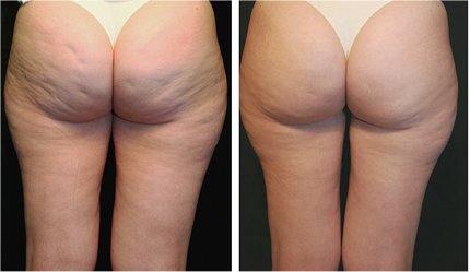 cellulite_4.jpg