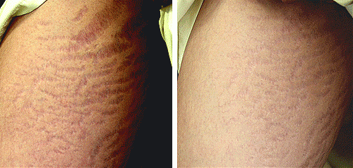 Stretch Mark Removal Before and After Photos, treatment, reduction