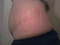 tummy_tuck__before_treatment-4.jpg