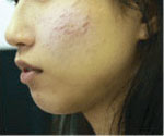 acne_before.jpg