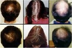 multiple_images_derma_rolling_hair_restoration.jpg