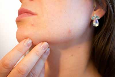 women with acne scar