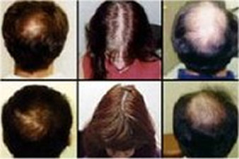 Derma Rolling For Hair Restoration