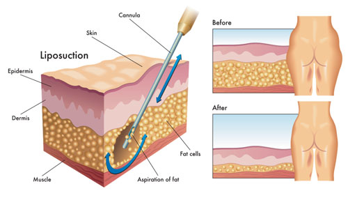 liposuction scars