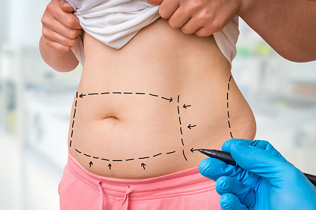Skin marks for liposuction and abdominoplasty